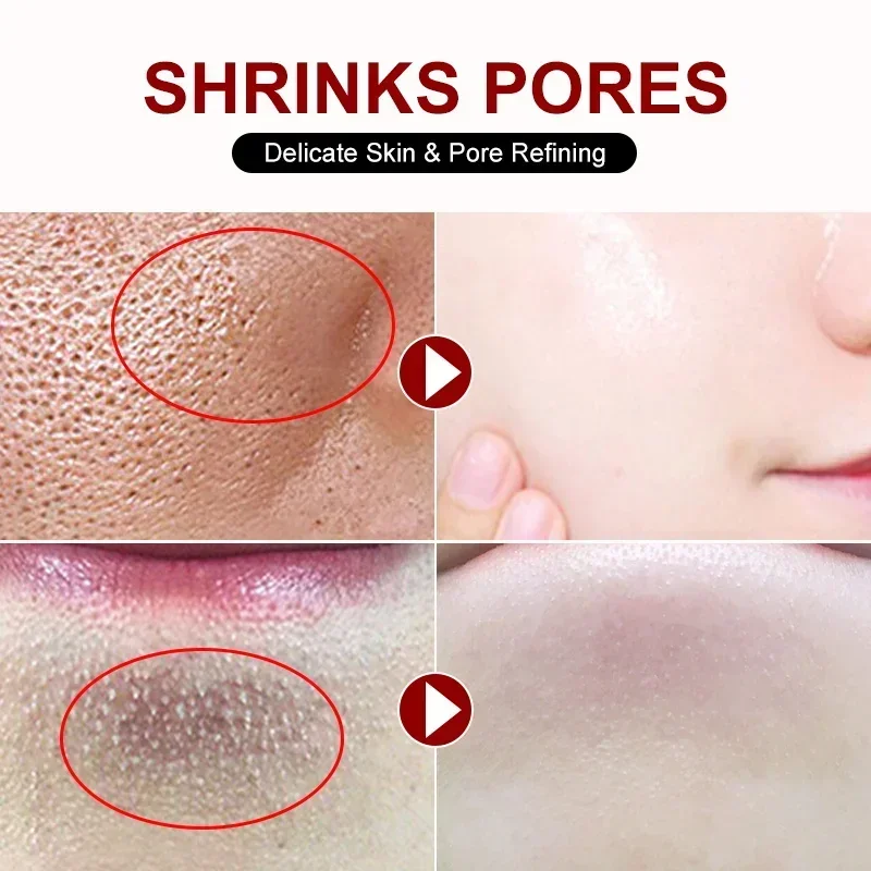 Salicylic Acid Pore Shrinking  - Skincare Salicylic Acid review and price